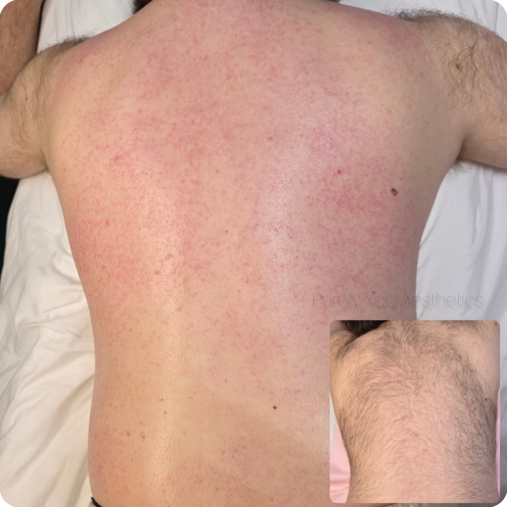 Full Back Wax at Purely You Aesthetics LLC in Quincy, IL