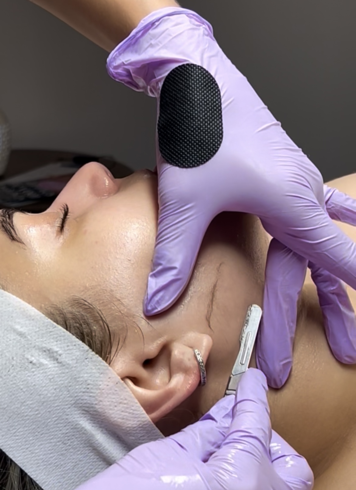 Dermaplaning