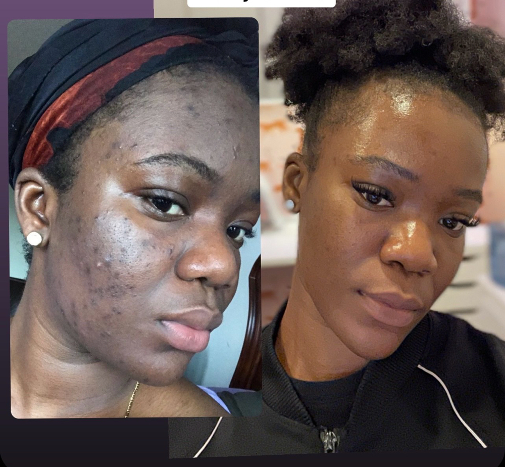 Chemical Peel