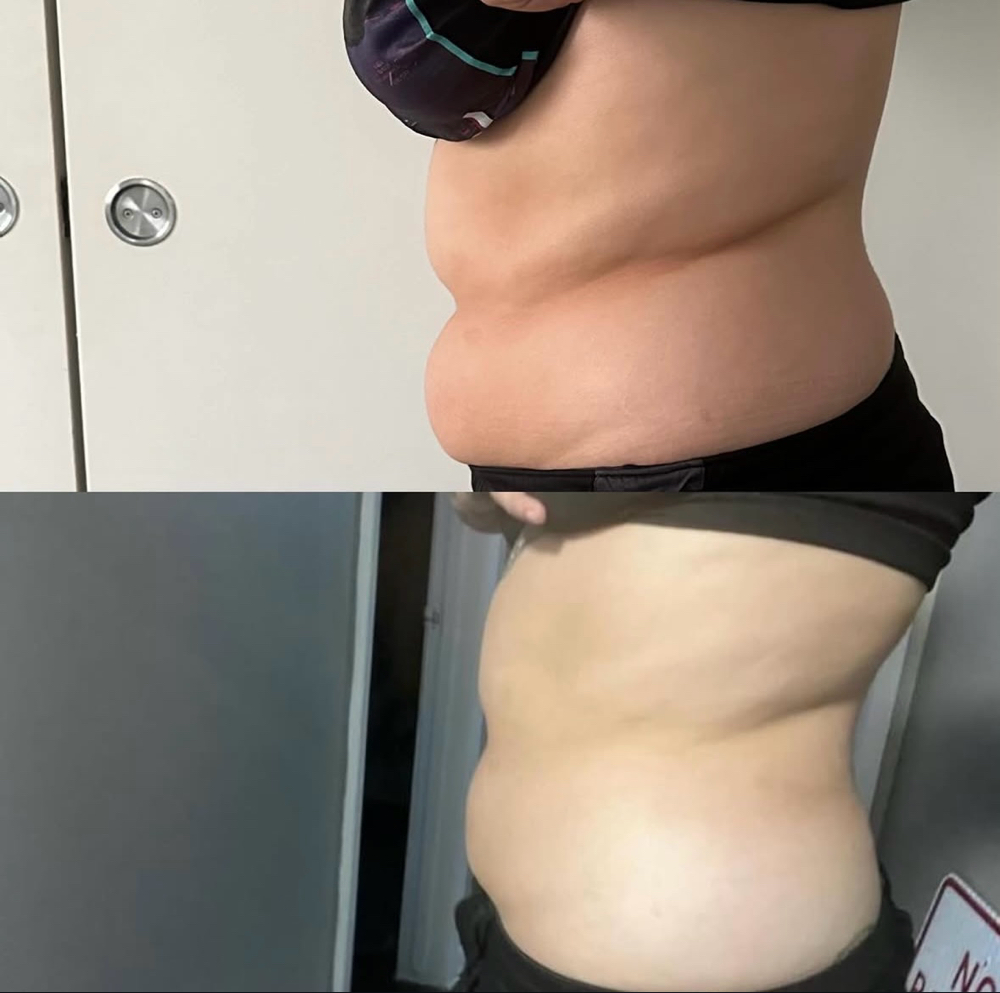 Liquid Lipo at BeautyByBernice in San Antonio, TX