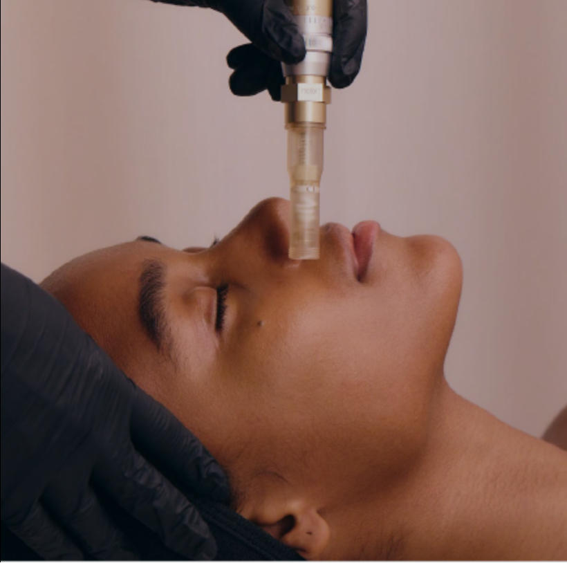 Nano- Needling at The Aesthetic Skincare in Mesa, AZ