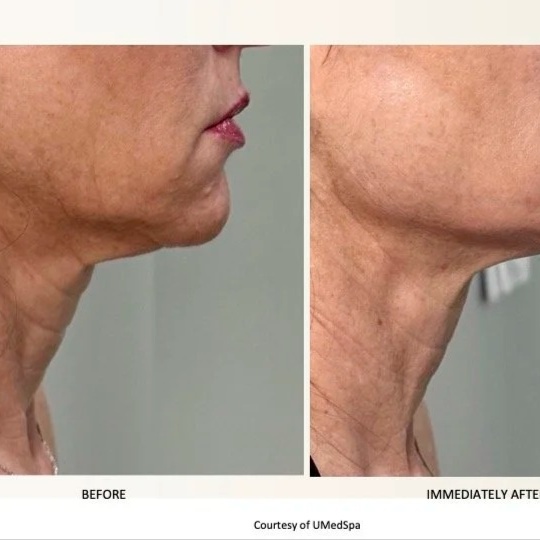 *Density RF Skin Tightening at Marco Island Aesthetics