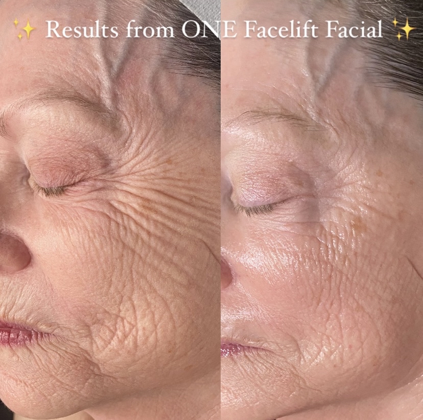 Facelift Facial