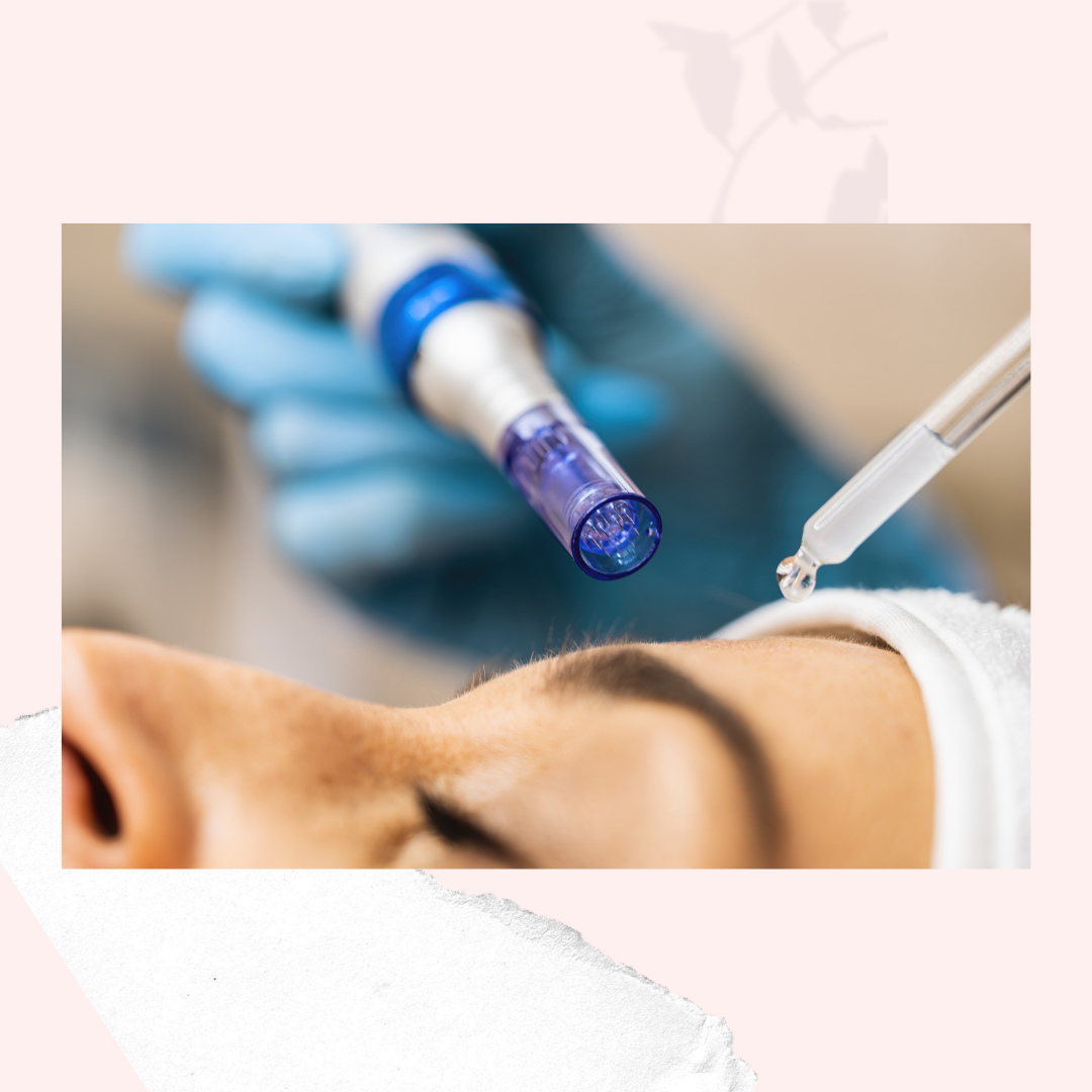 Microneedling Facial Treatment at I.S Beauty Studio in Cumming, GA