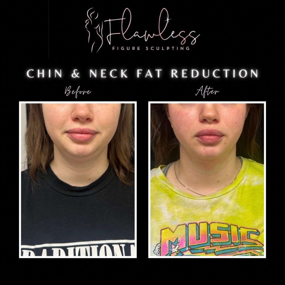 Chin & Neck Fat Reduction - 4 Pack