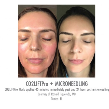 Microneedling w/HA/exosomes at Muy Bueno Injections by Pat MSN RN in San Antonio, TX