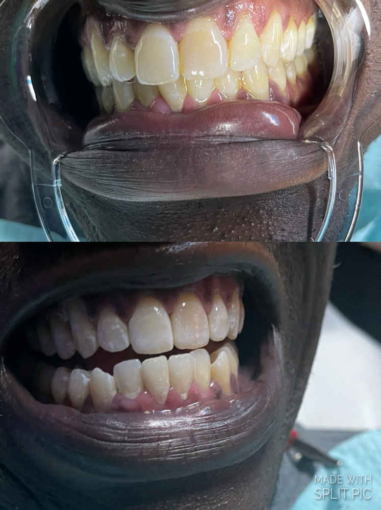 Teeth Whitening