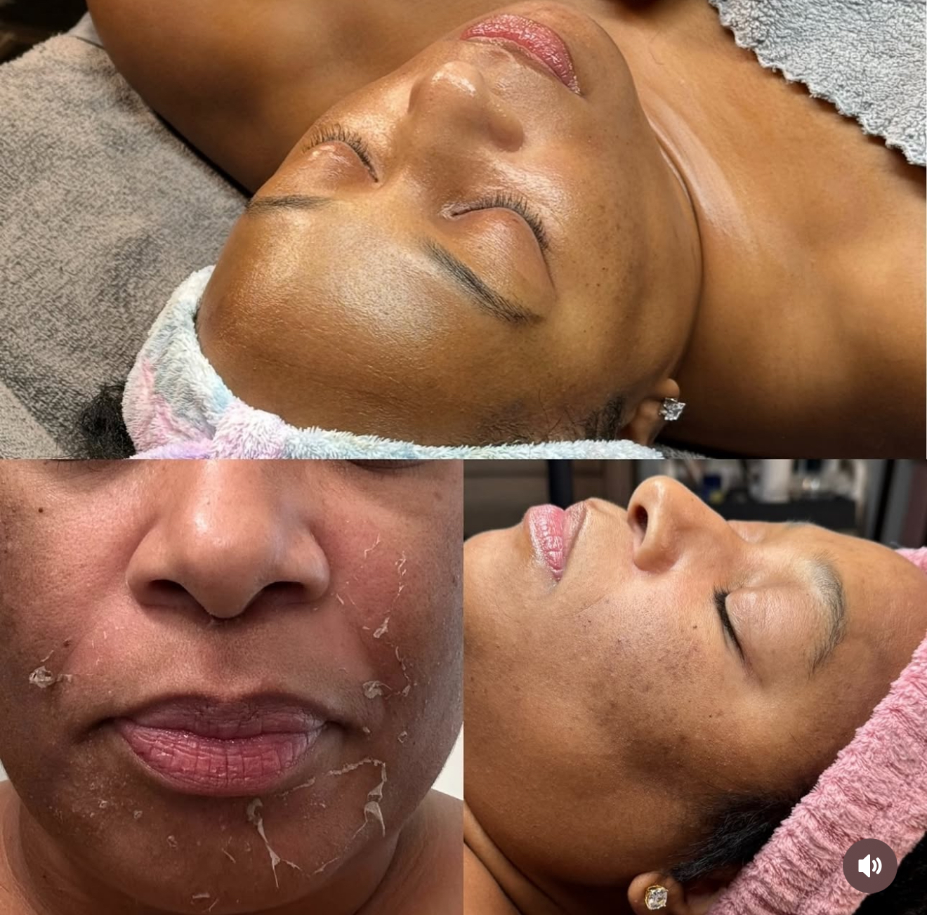 The CHEMICAL PEEL Facial