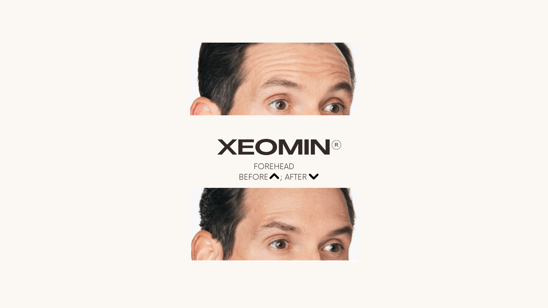 Xeomin®
