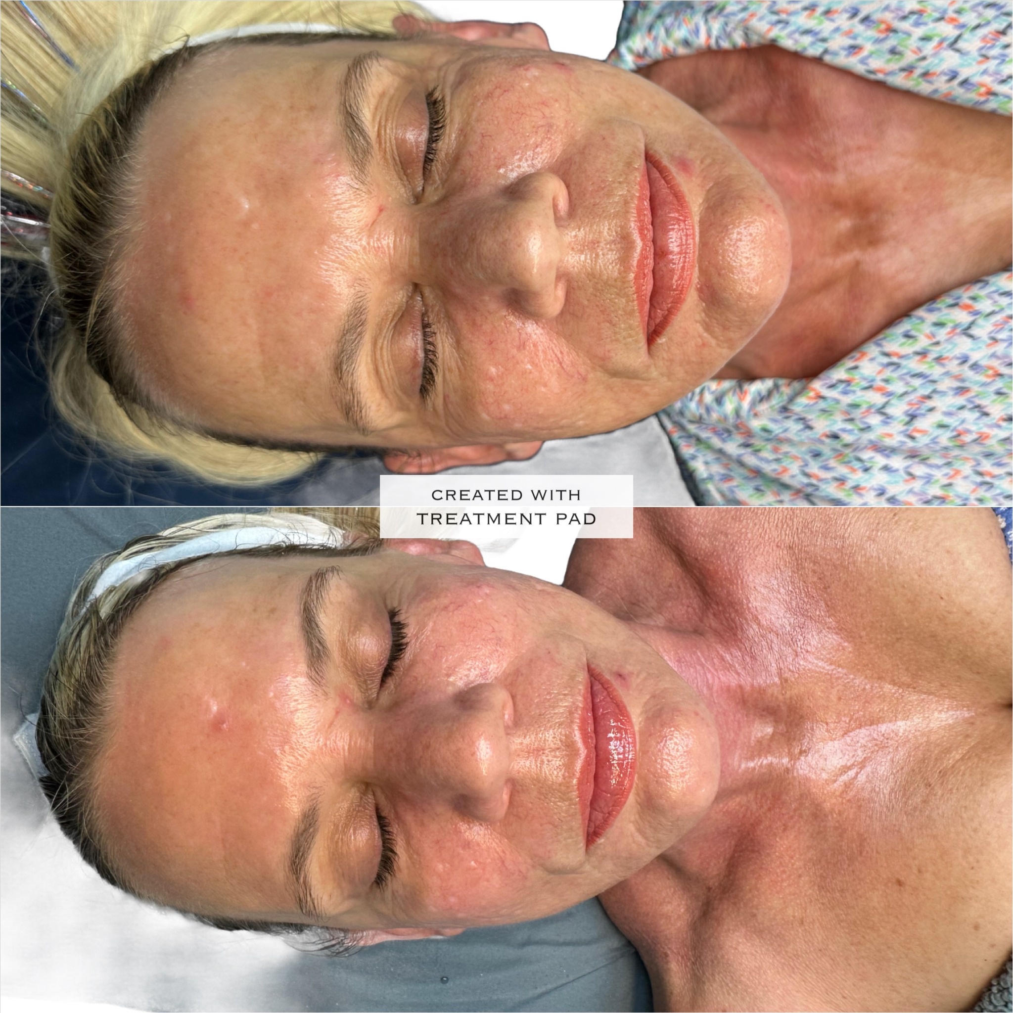 PRX DERM PERFEXION at Marco Island Aesthetics