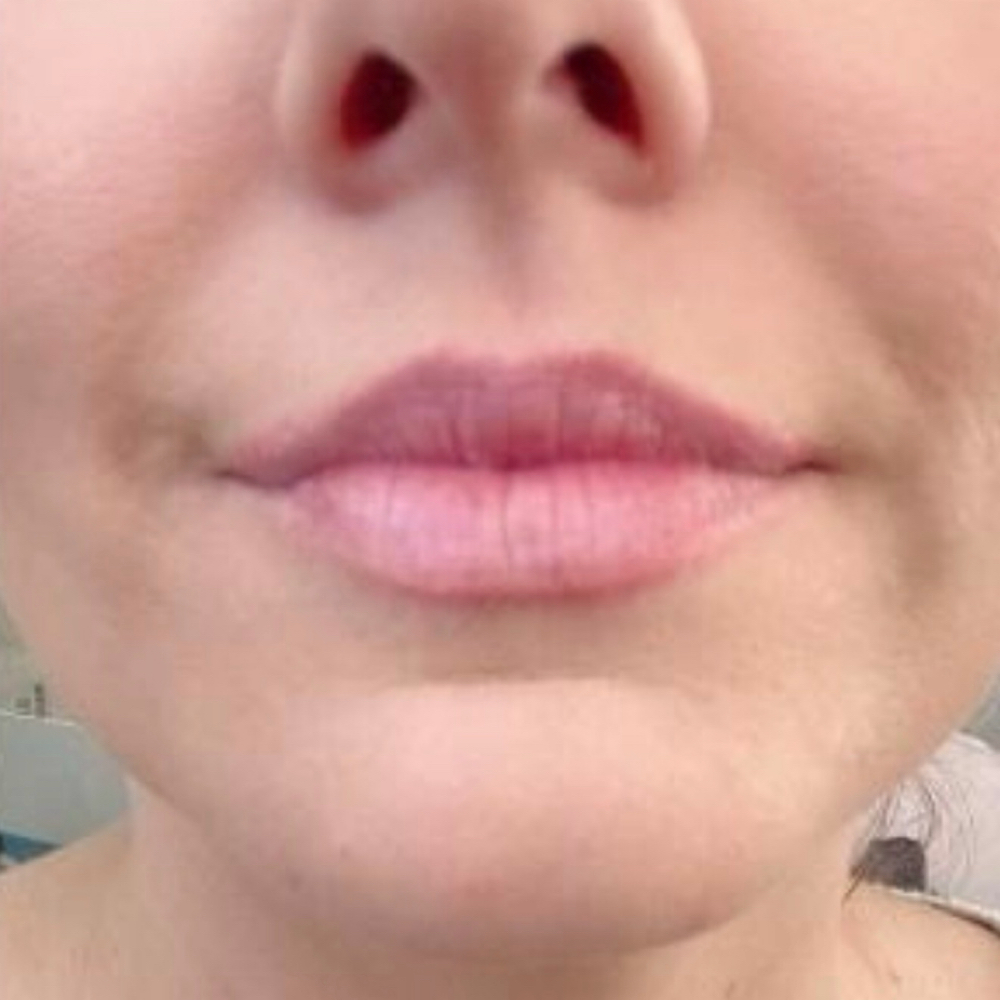 Lip Enhancement (Lip Flip) at Redeemed Radiance Aesthetics & Cosmetic Injections in San Antonio, TX