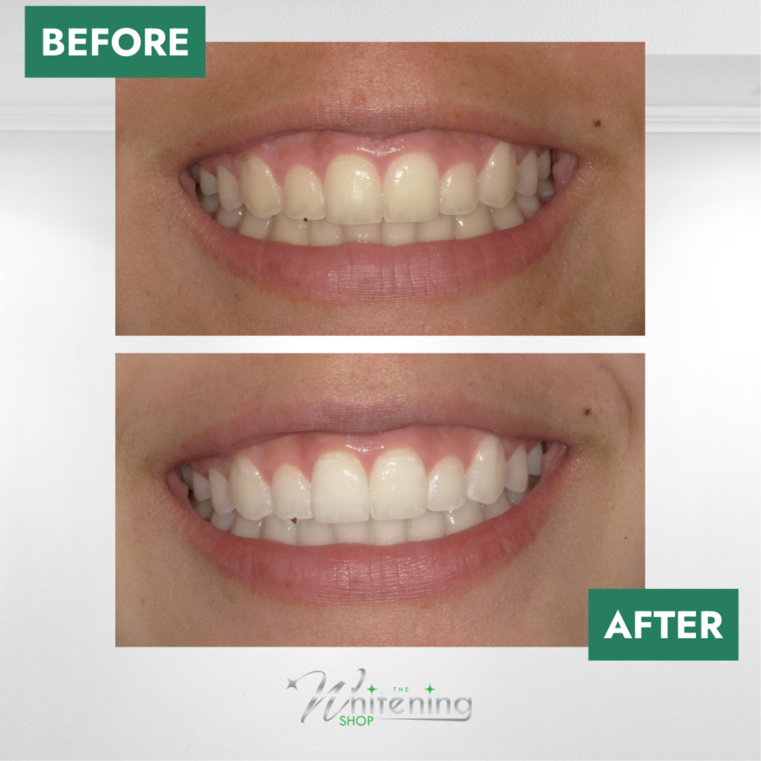Teen Whitening at The Whitening Shop in Virginia Beach, VA