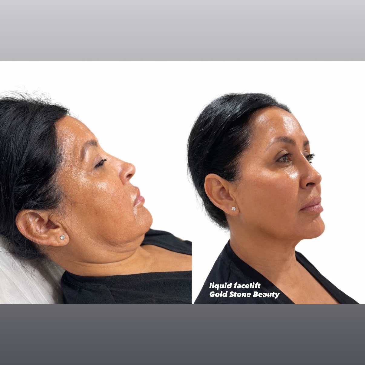 Filler Liquid Facelift at Gold Stone Beauty in mcallen, TX