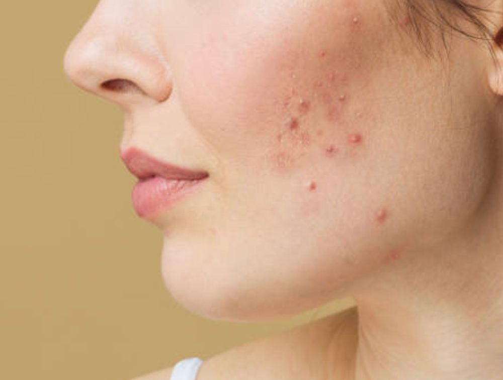 Acne Clinic Consultation