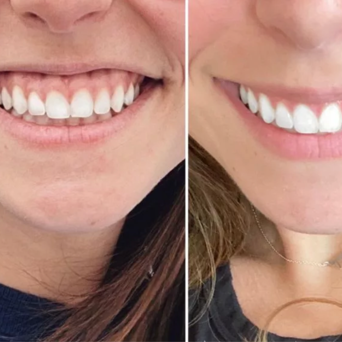 Gummy Smile Treatment at Aesthetics by AM in Council Bluffs, IA