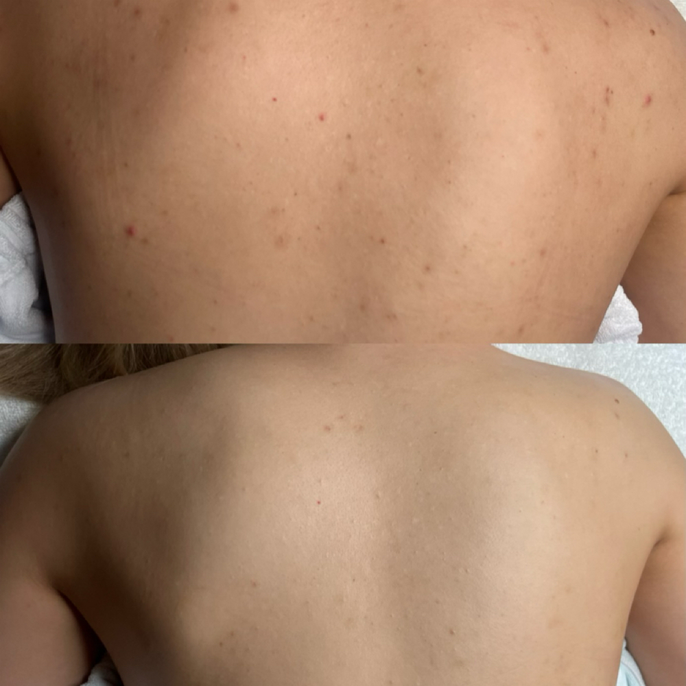“I Got Your Back” Treatment at LeClair Aesthetics in Wichita, KS