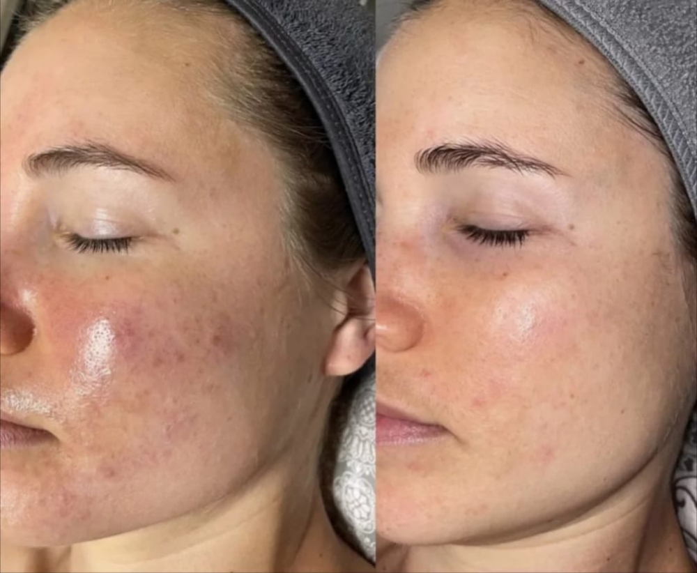 4 Liquid Gold Microneedling Facial