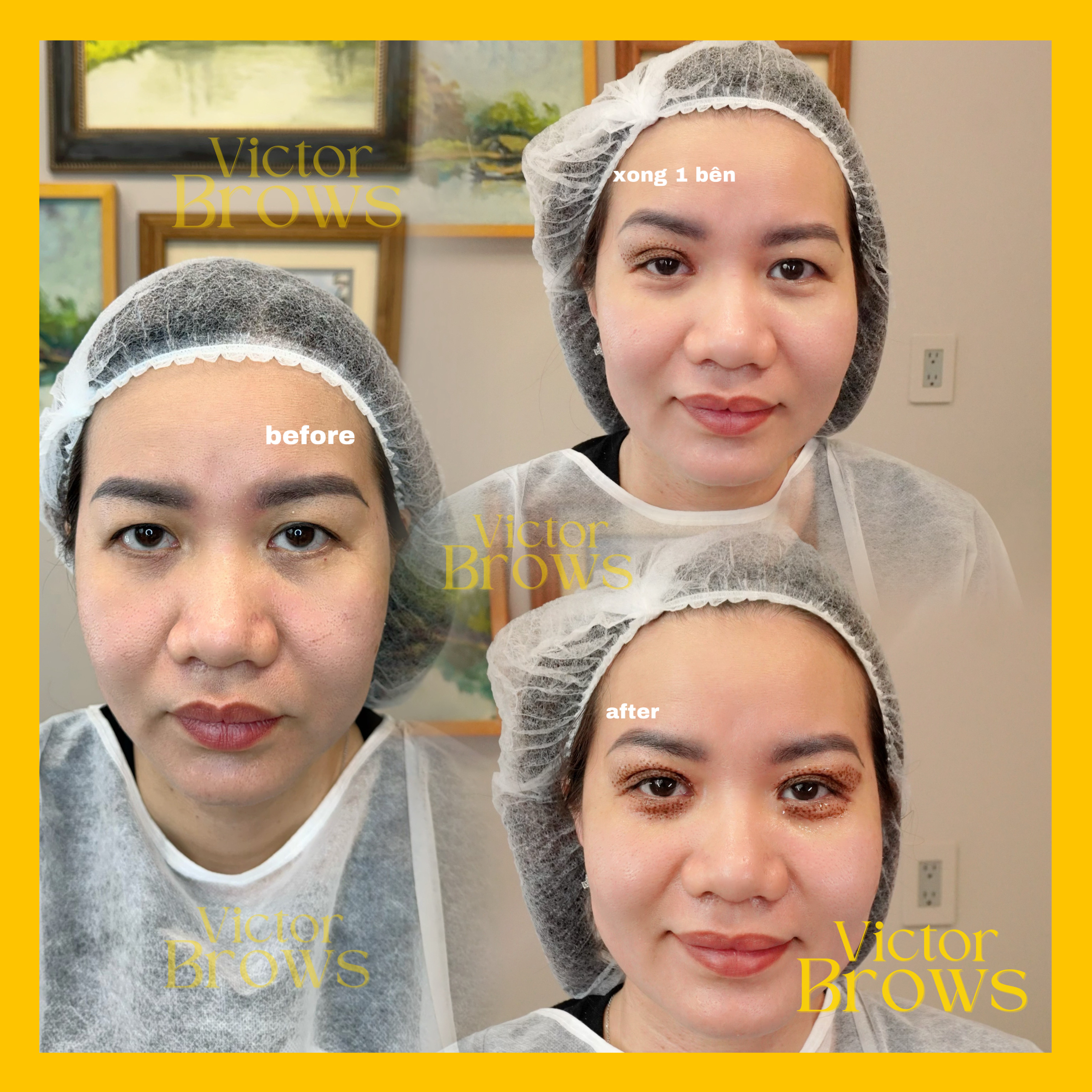 PLASMA EYE LIFT