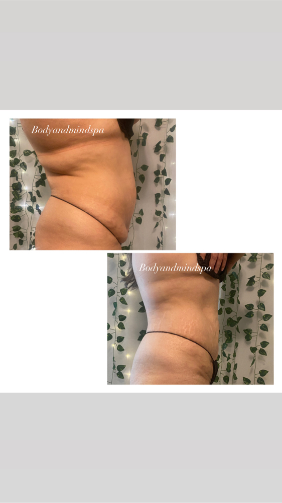 6 Sessions Mommy Make Over Tummy