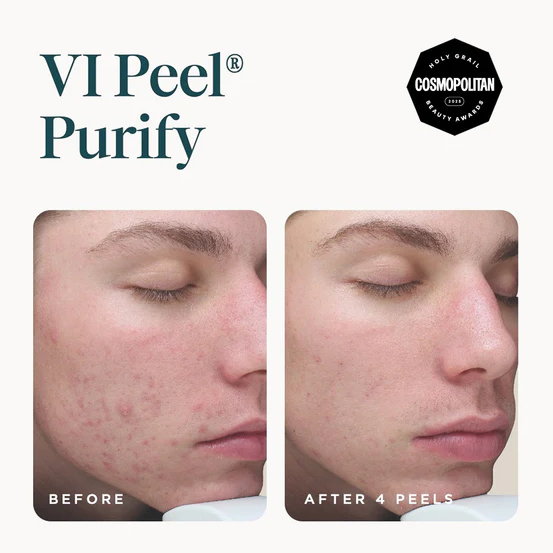 VI Peel Purify