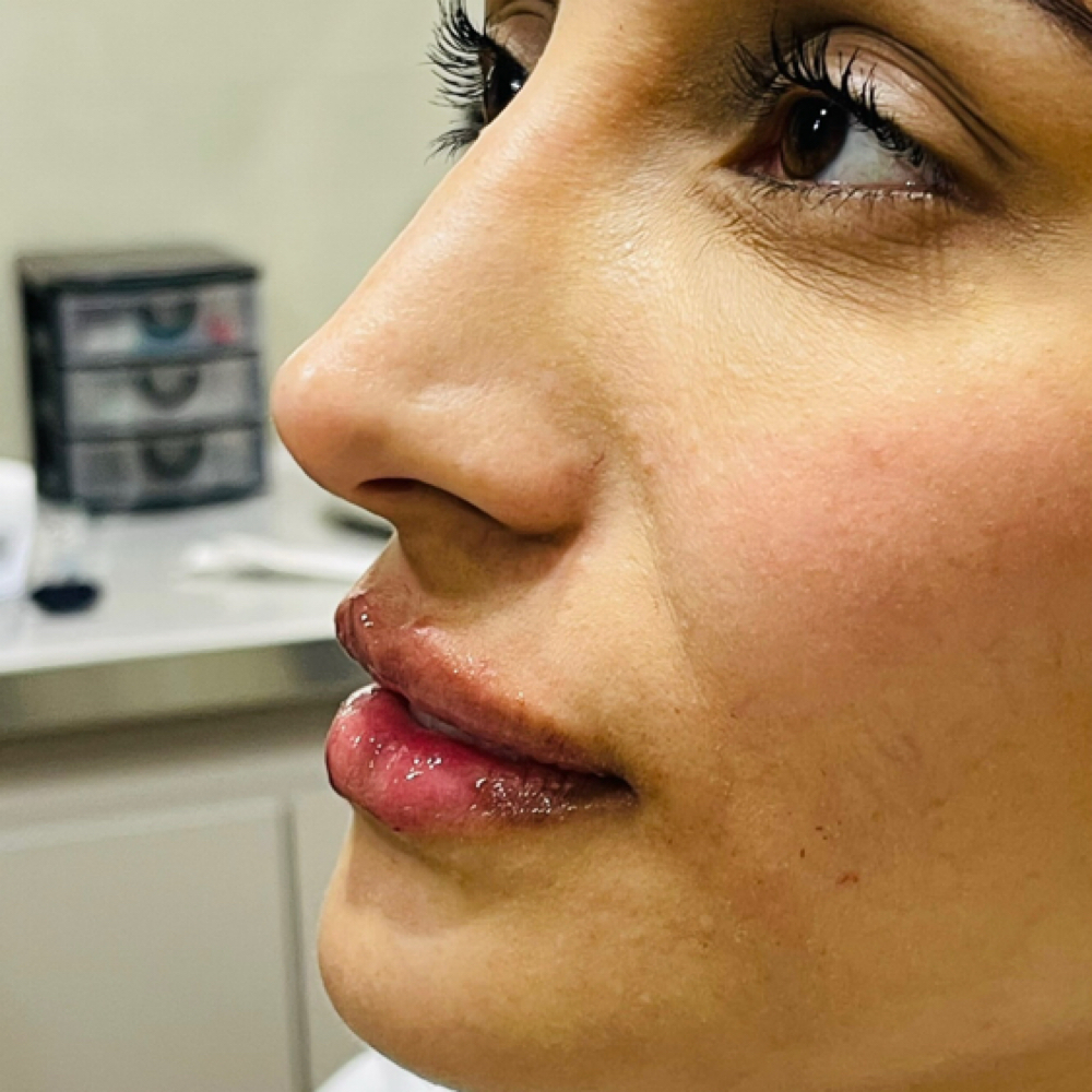 Microneedling at U•Glow by Laura Mesa in Tampa, FL