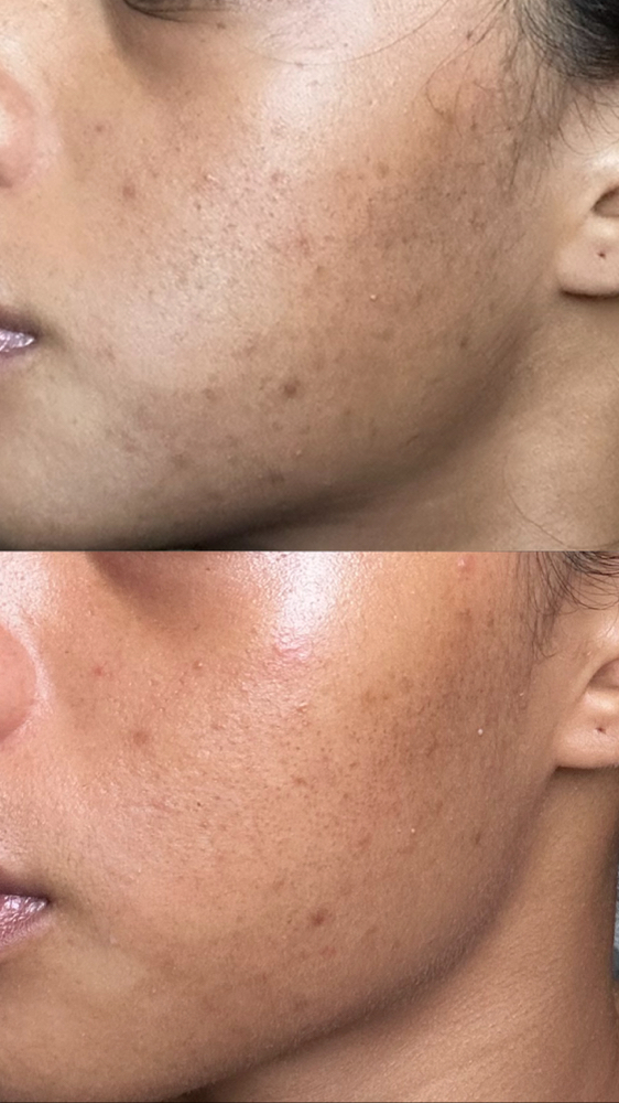 Illumin Glow Peel