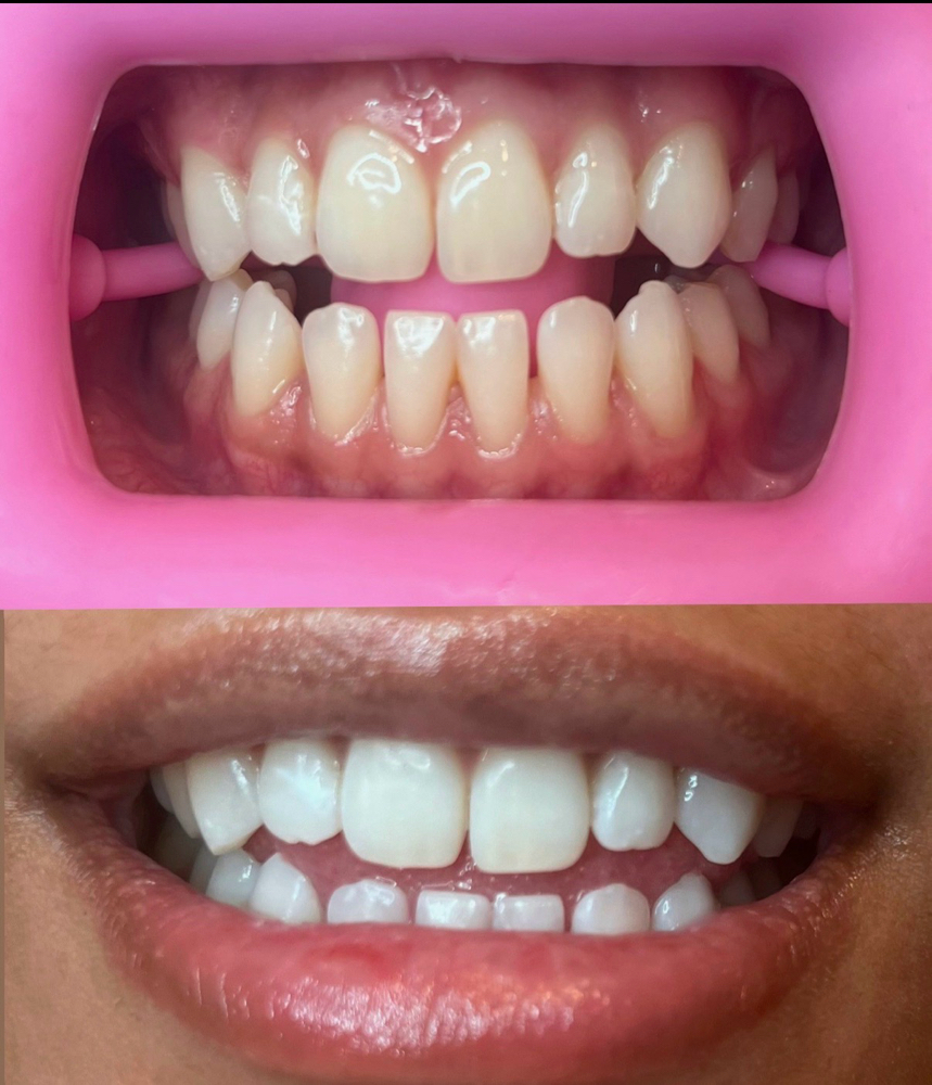 NEW CLIENT Teeth Whitening at Skin Promises in Las Vegas, NV