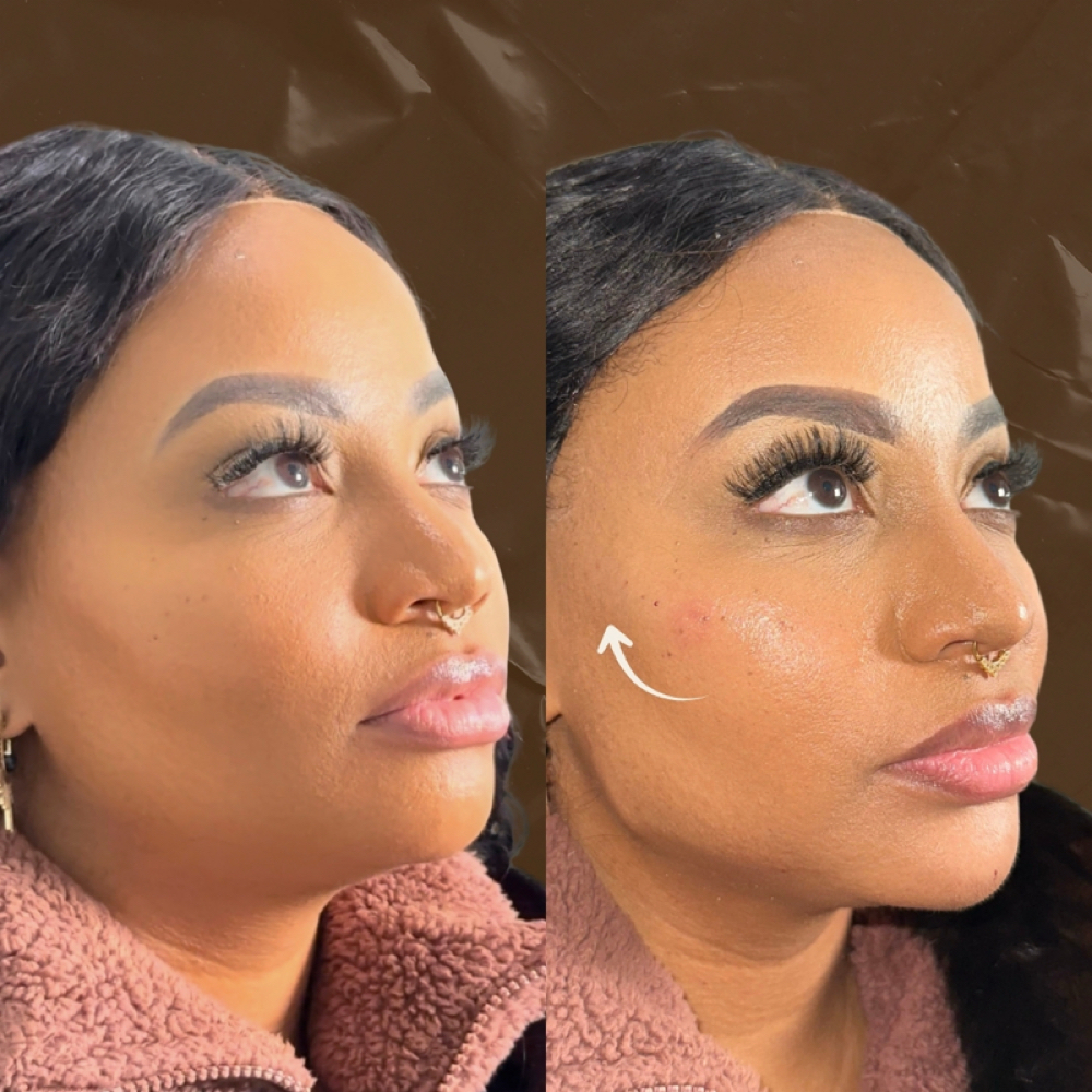 Cheek Filler at Aether Aesthetics in Midland, TX