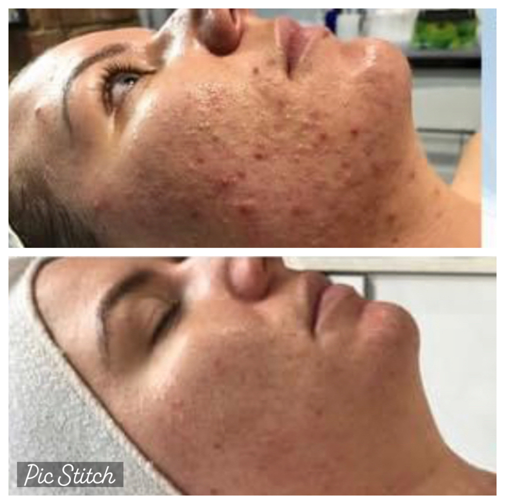 Oxygen Rx Treatment + Enzyme Peel