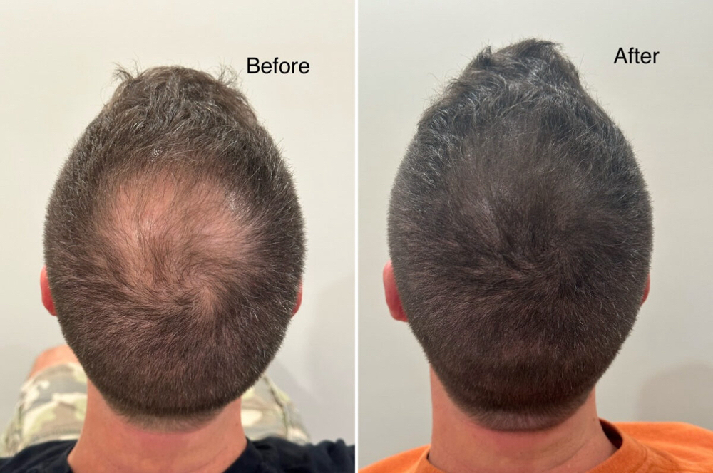 Scalp Micropigmentation