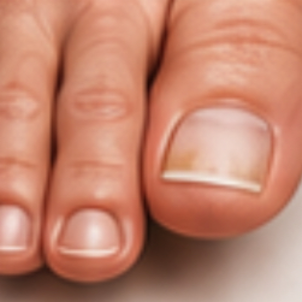 Toenail Fungus Therapy at Plasmalift Skin Clinic LLC in Bettendorf, IA
