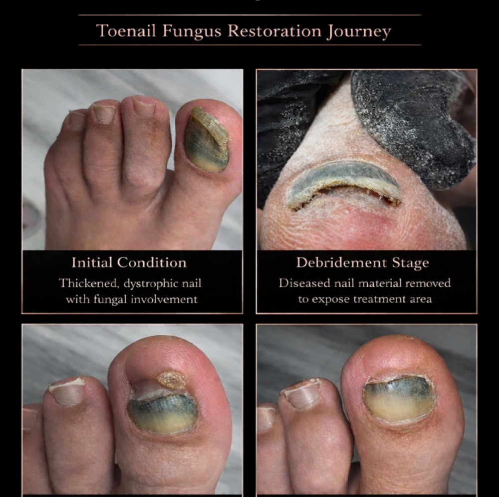 Fusion Plasma Fungal nail treatment at Plasmalift Skin Clinic LLC in Bettendorf, IA