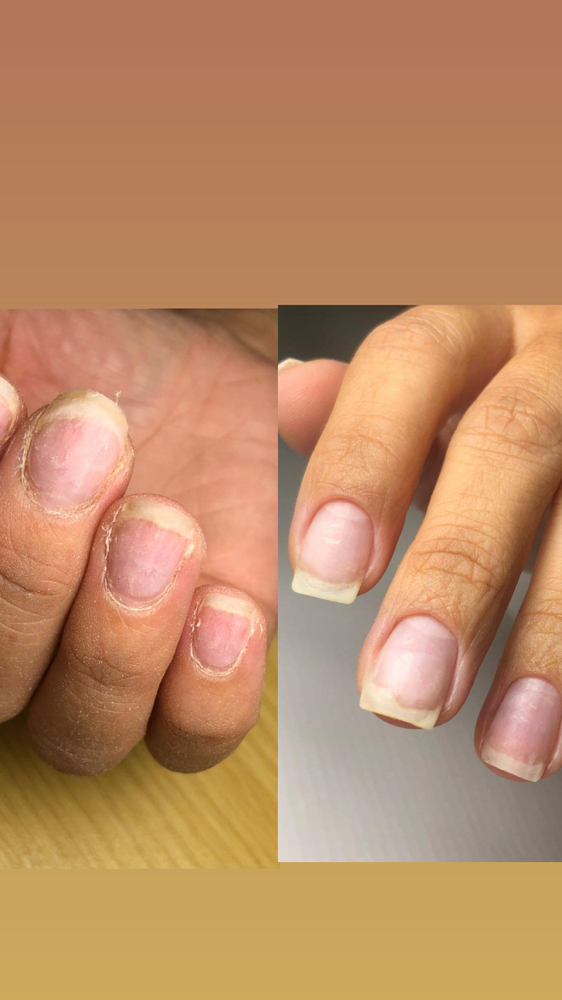 Nail reconstruction