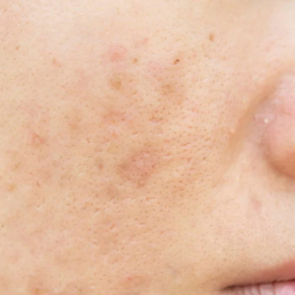 IPL Pigment Spot Treatment at Island Glow in Londonderry, NH