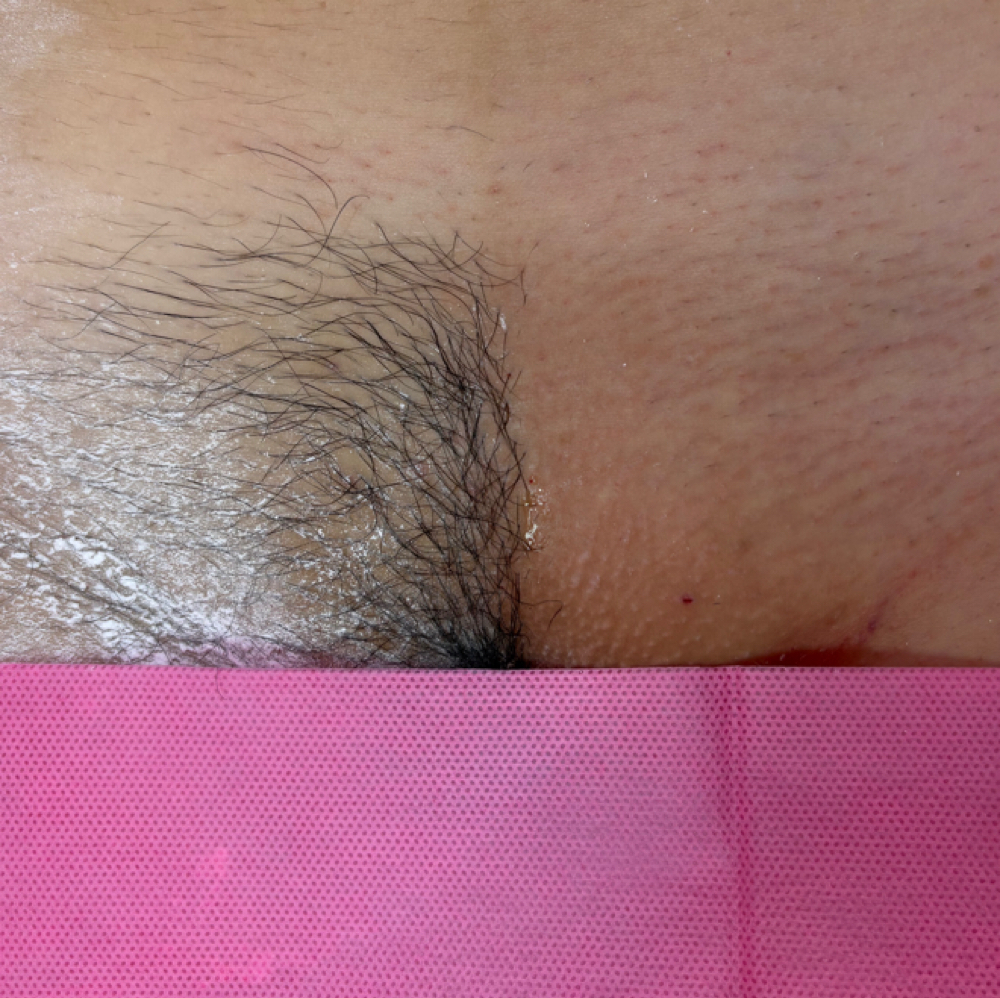 Bikini Line at Bella By Magali in Rogers, AR