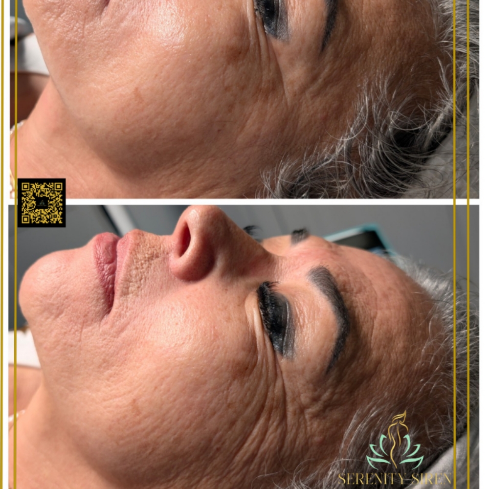 Siren Age Defying Lift at Serenity Siren in Portland, TX