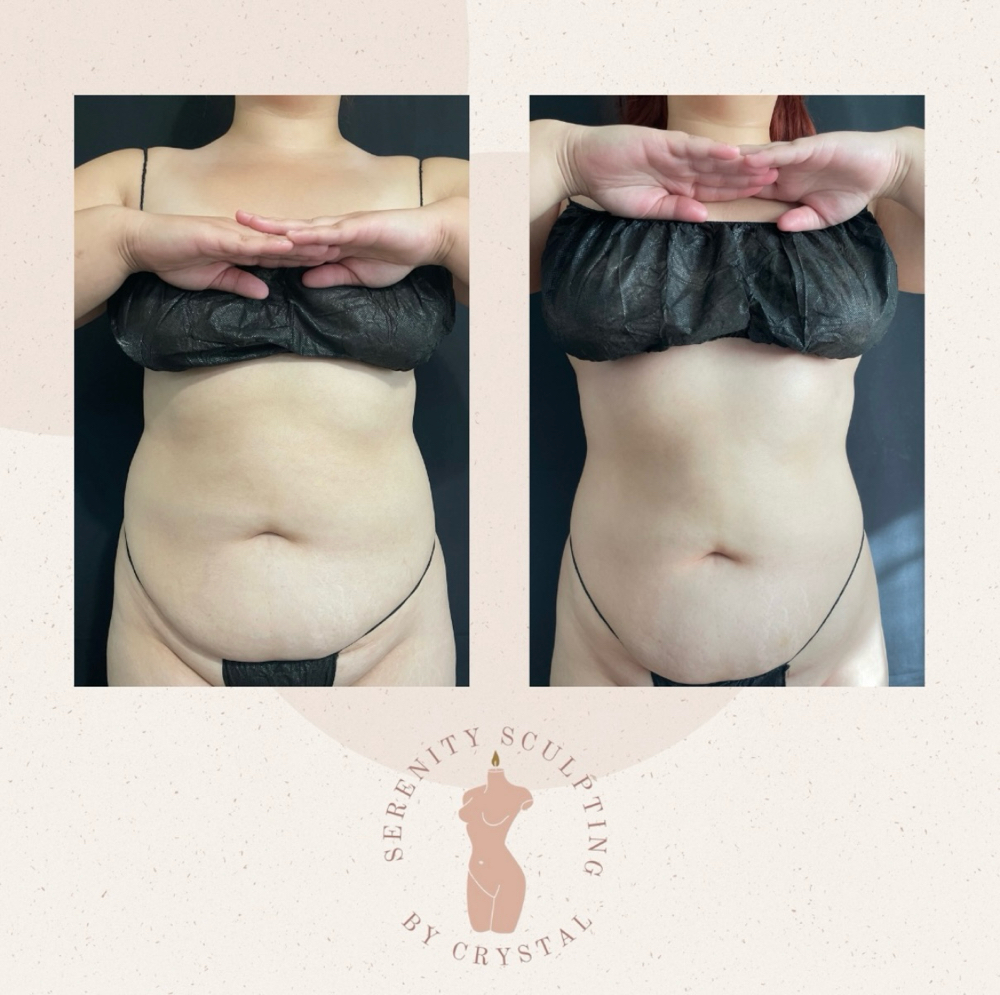 The Sculpted Tummy at Serenity Sculpting in Madera, CA