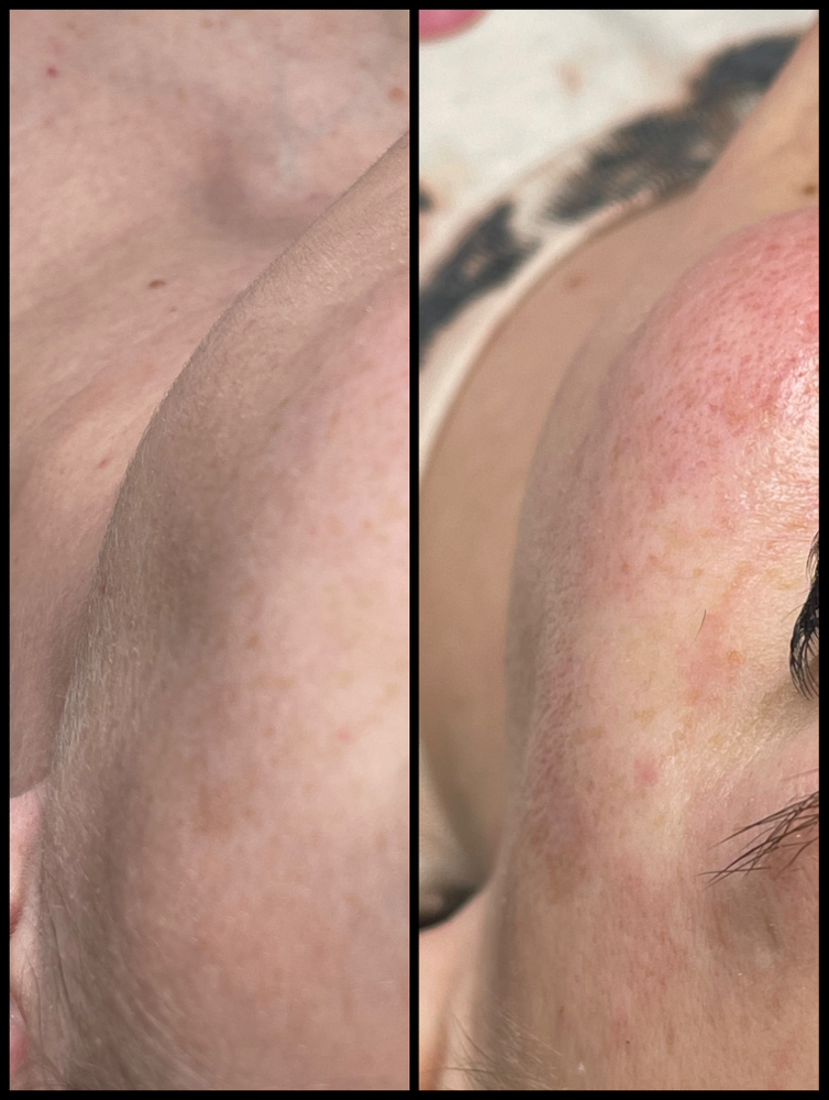 Dermaplane Add On