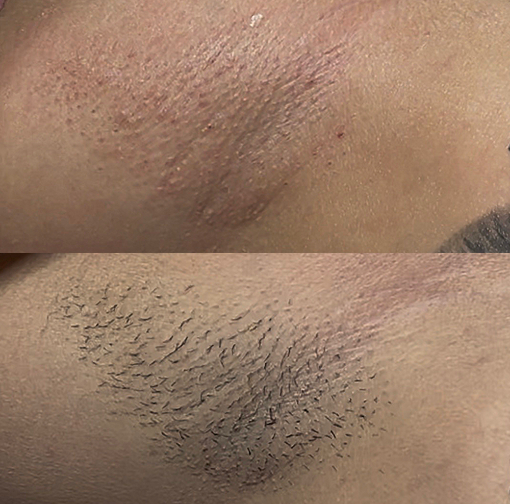 Underarm Wax