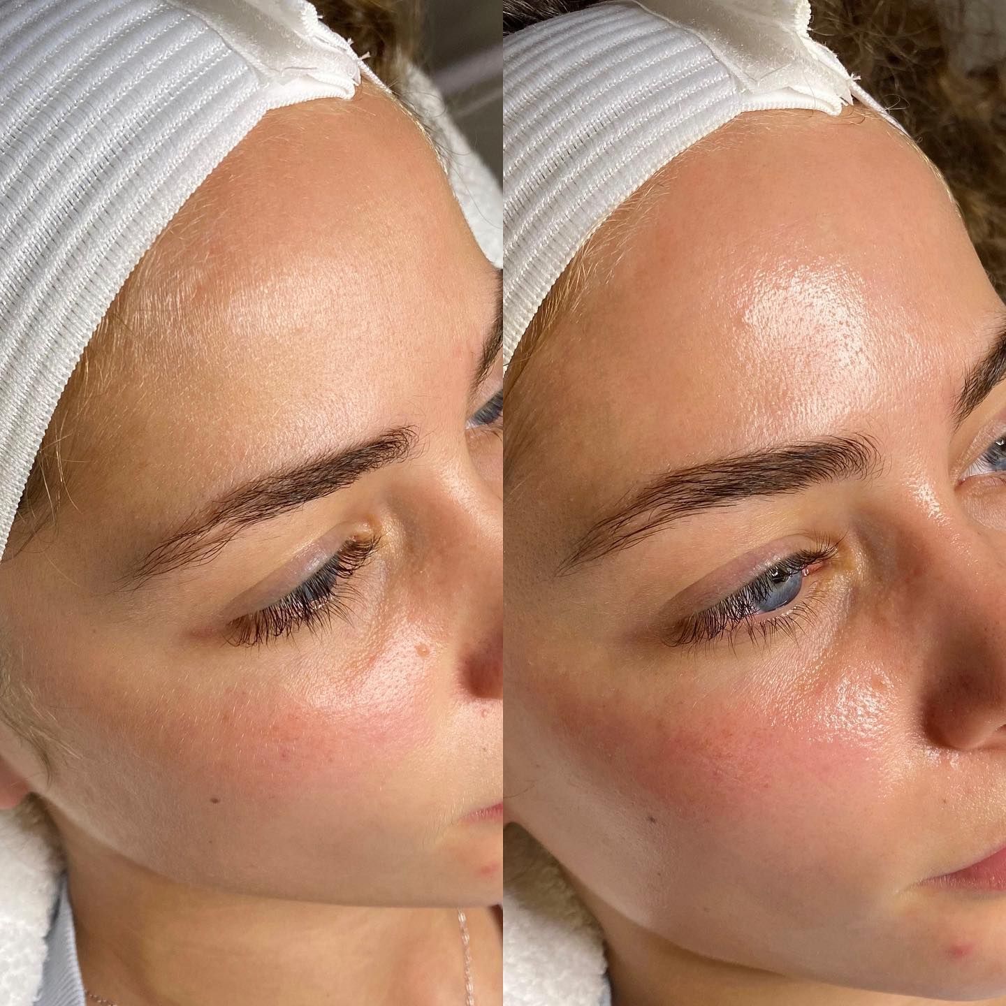 Dermaplane Facial