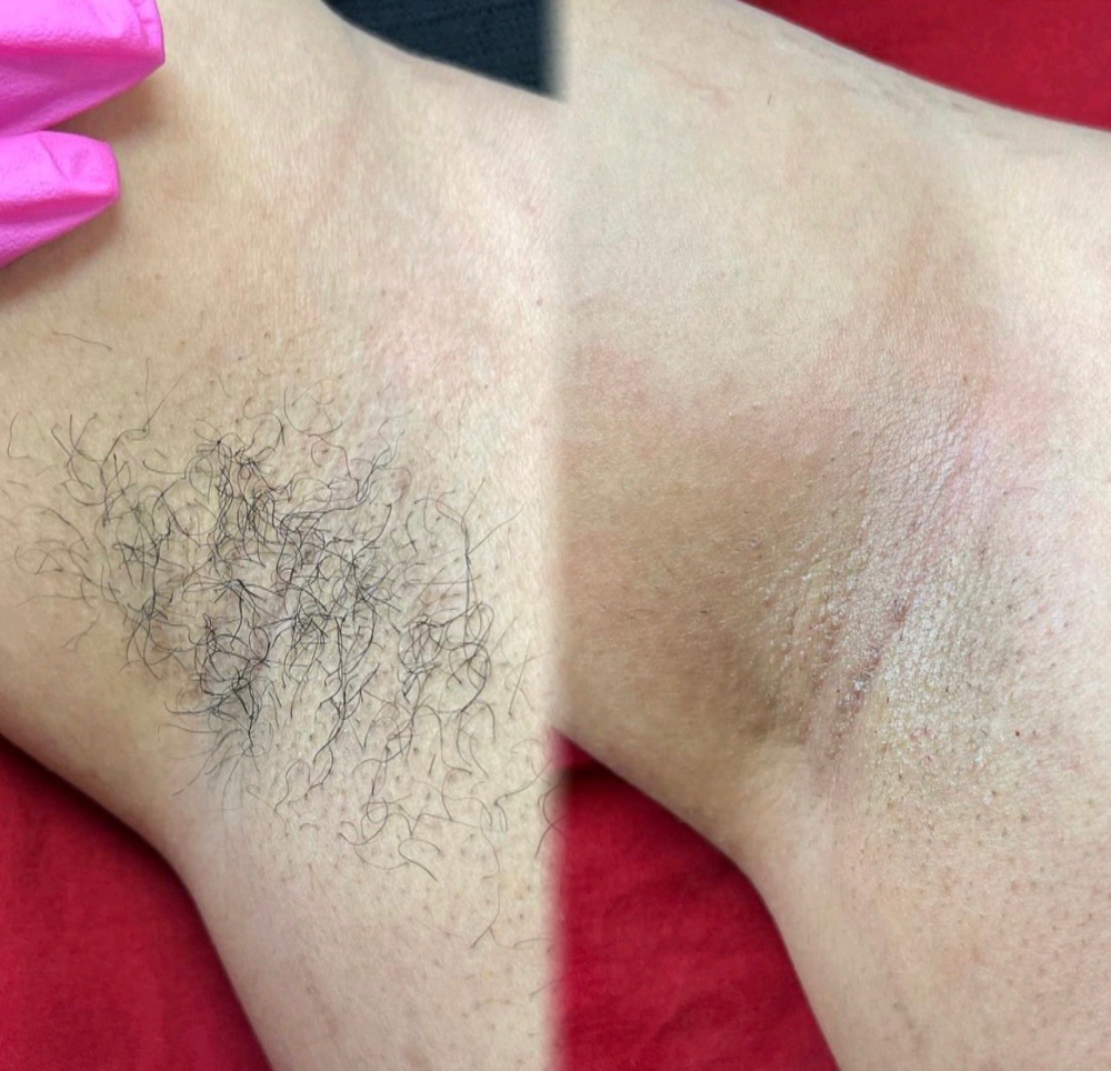 Underarm Wax