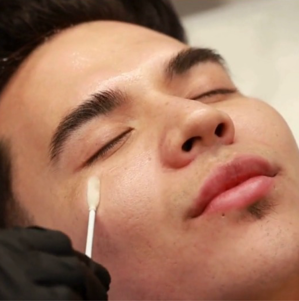 Depigmentation Peel at GlowDerm Clinic in San Jose, CA