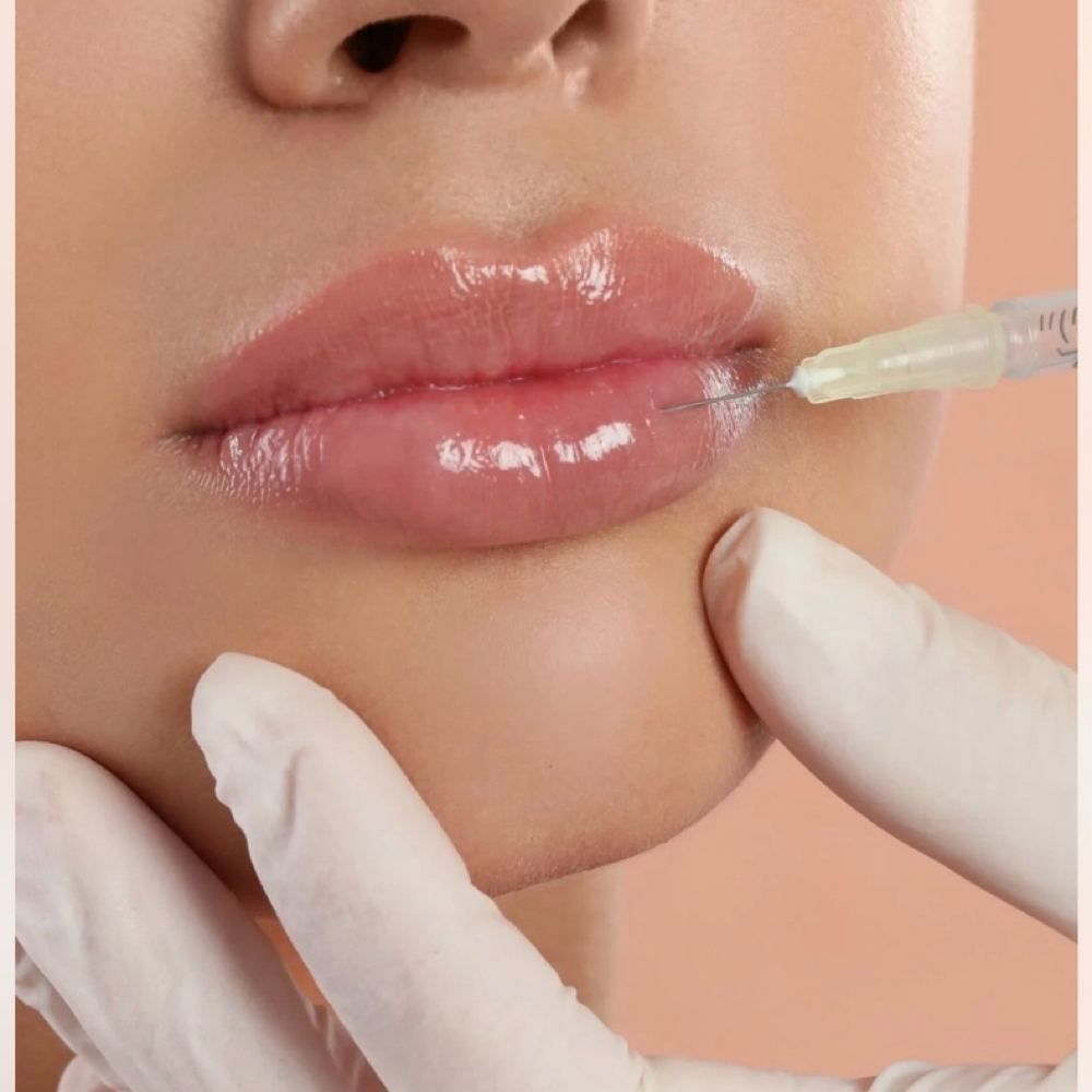 Filler at VitaGrace Aesthetics in Rockwall, TX