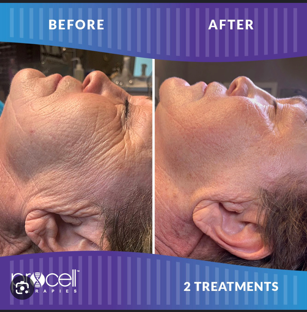 Procell Microchanneling MD Grade at Barevia in Tempe, AZ