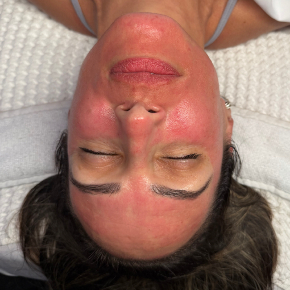 Rejuvapen Microneedling at One Skin by Mabel in Palmetto Bay, FL