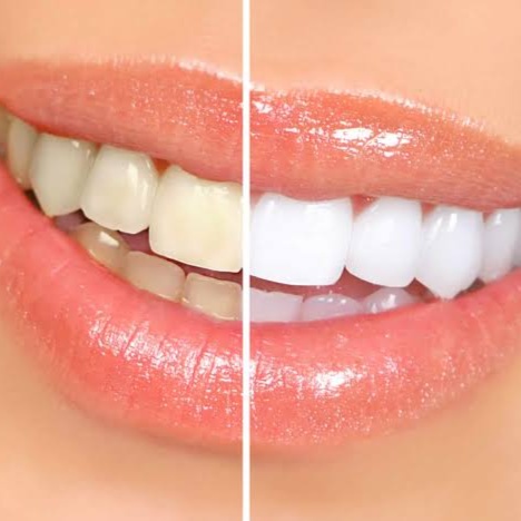 Teeth whitening treatment at Twilla MedSpa in Fort Smith, AR