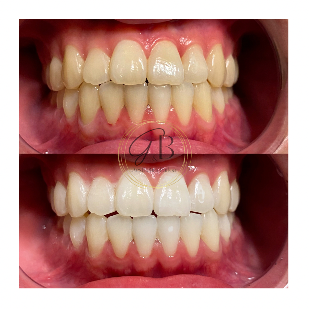 Teeth Whitening Training