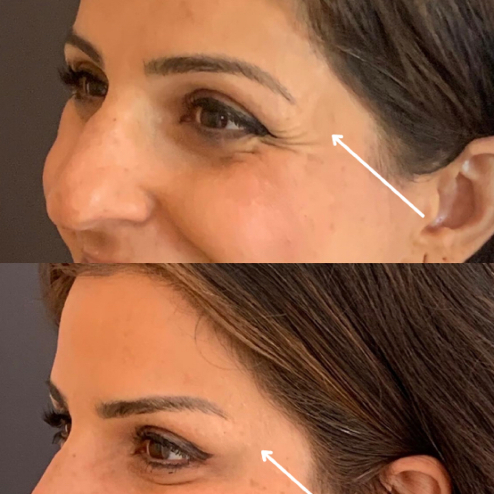 Brow Lift at The Inkjectables Lab in El Paso, TX