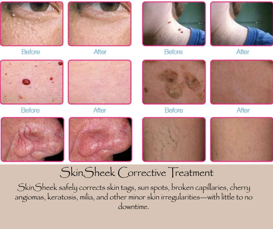 SkinSheek Corrective Treatment