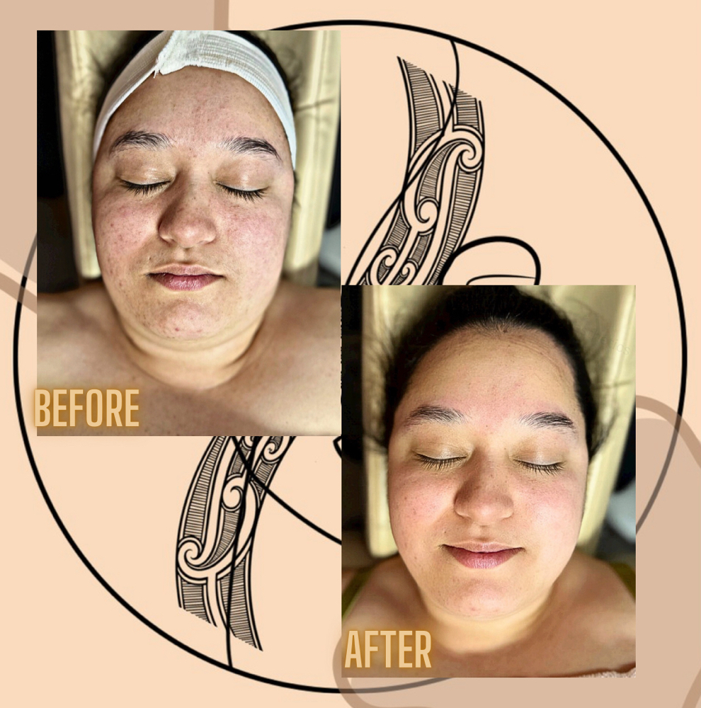 Microdermabrasion Facial at Mana Aesthetics in Las Vegas, NV